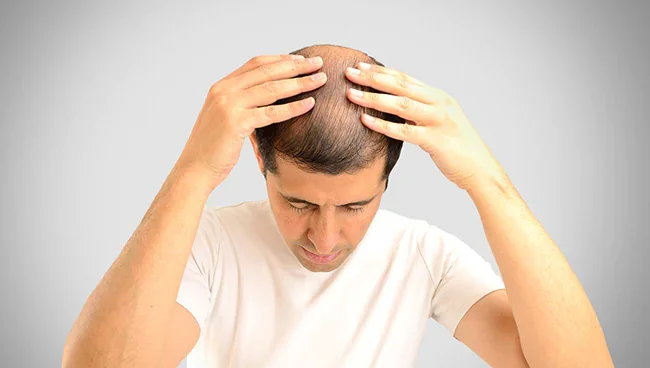 doctor showing results of hair restoration with big fue technique