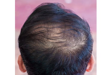 a man showing telogen effluvium - type of hair loss