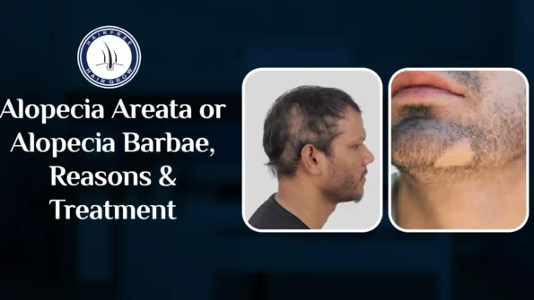 Alopecia Barbae vs Alopecia Areata: A comparison showing hair loss on the scalp and beard with patchy bald spots