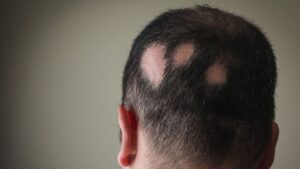 Alopecia areata 1