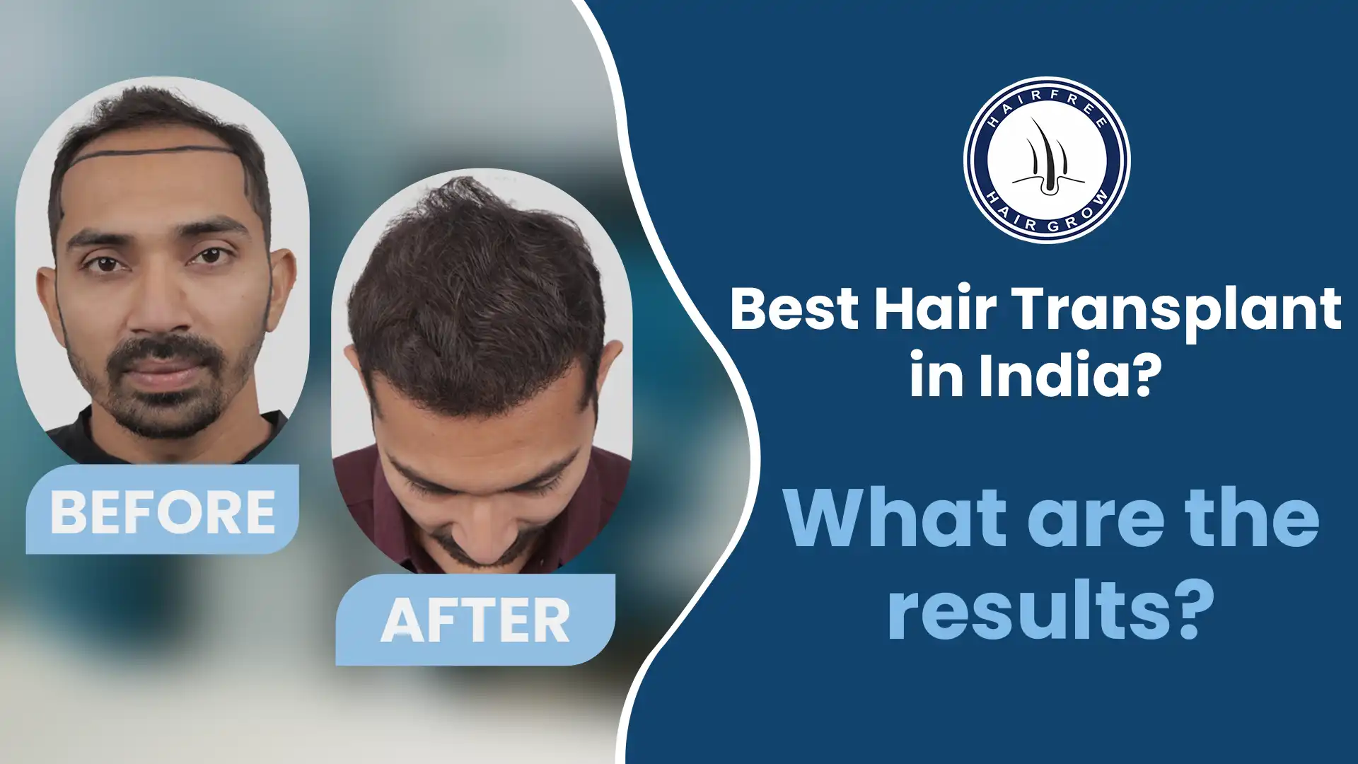 Best Hair Transplant Results for natural-looking hair