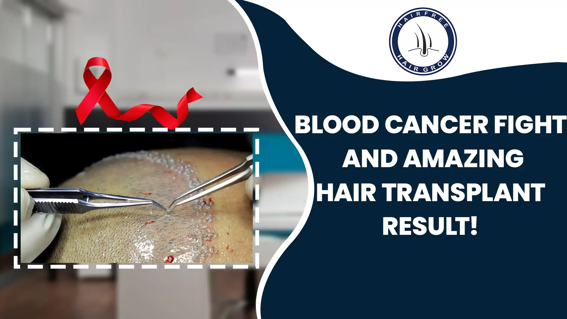 Blood cancer recovery with amazing hair transplant results