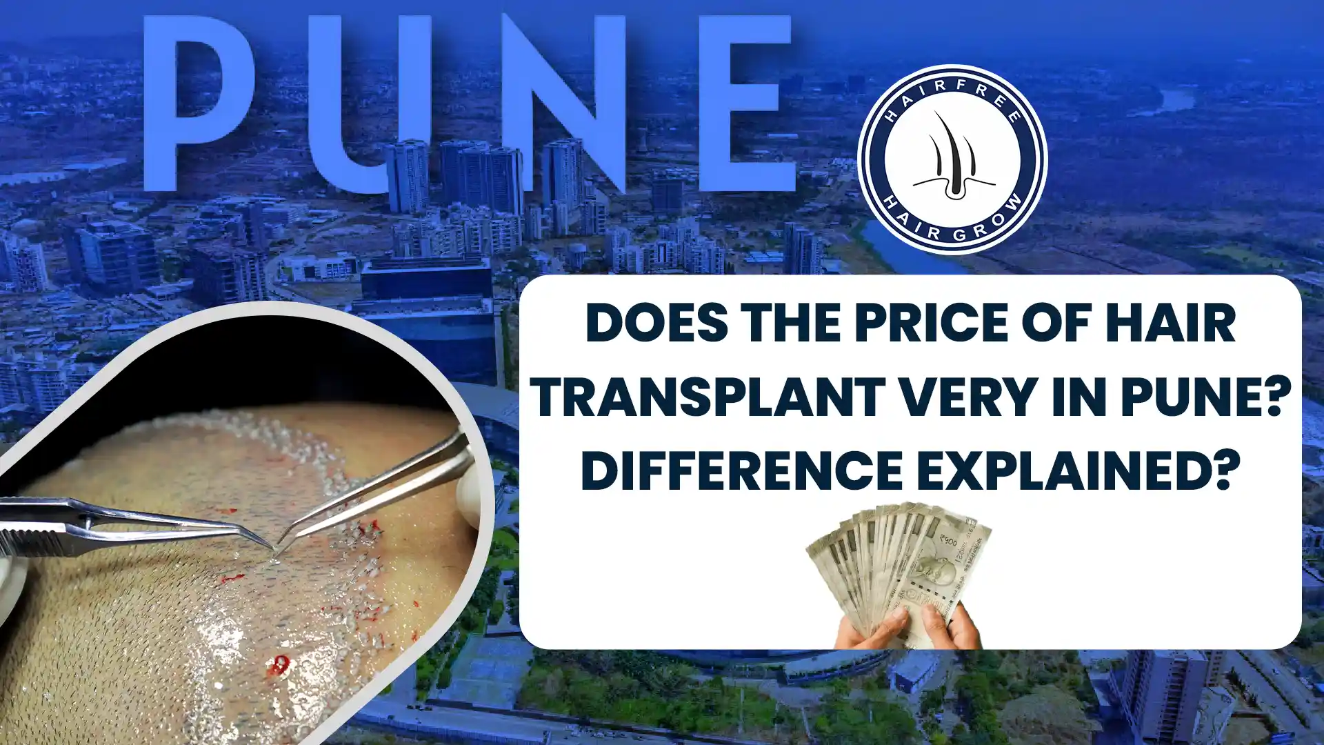 Price of Hair Transplant in Pune explained with cost differences.