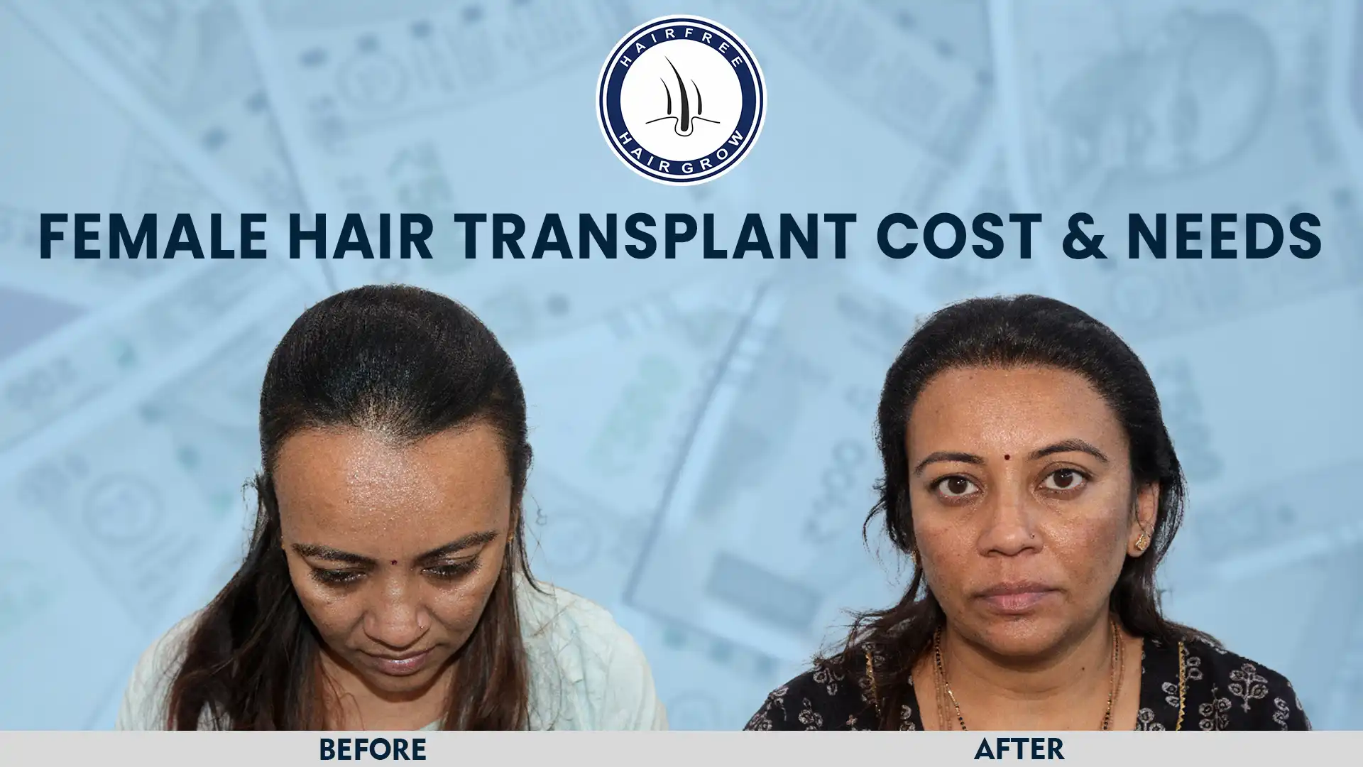 Female Hair Transplant Cost and results shown in before and after images