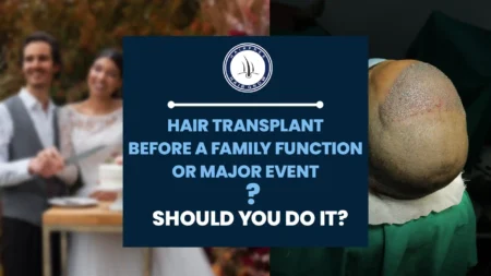 Is a Hair Transplant before a Family Function the right choice for you