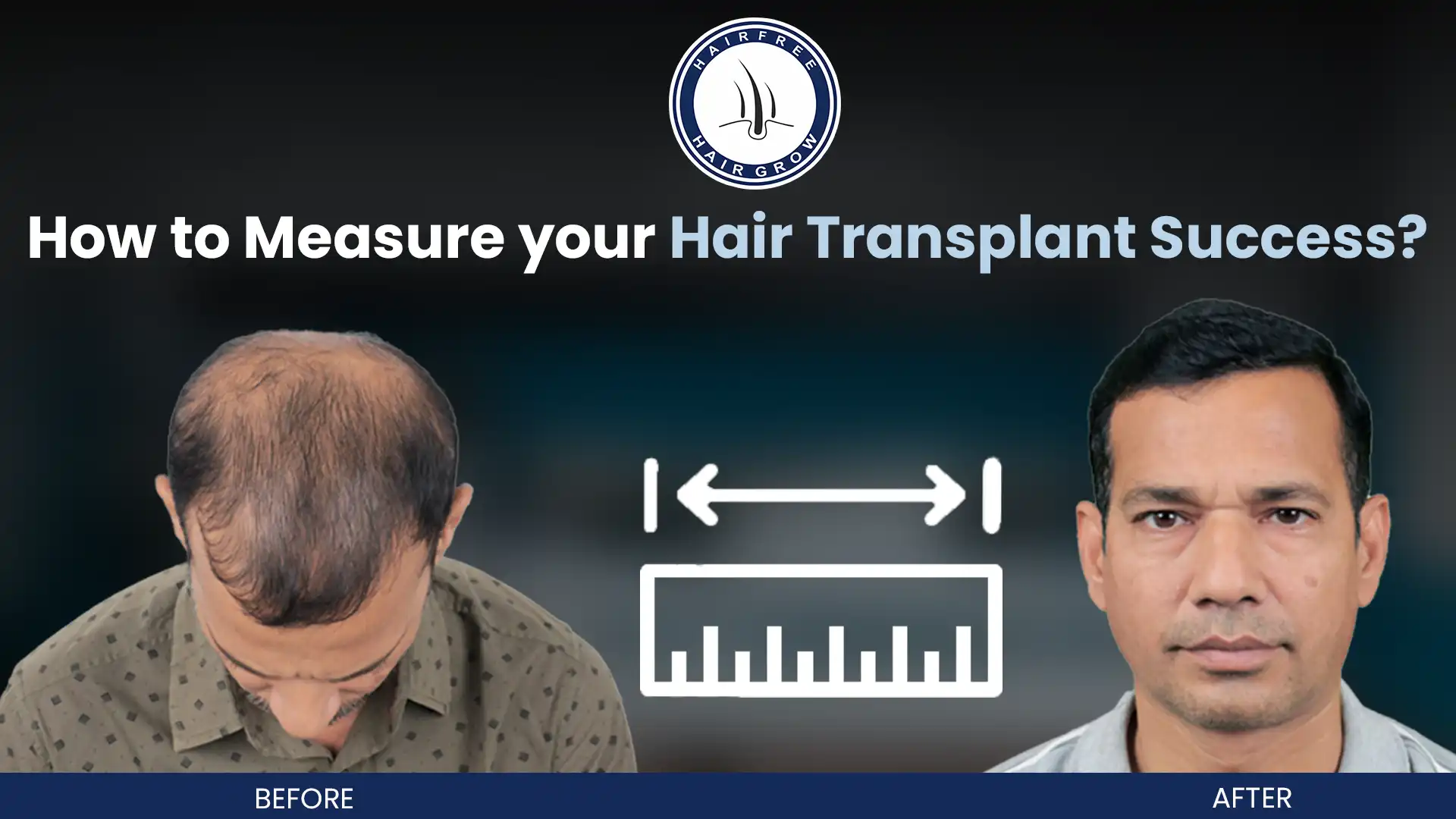 How To Measure Your Hair Transplant Results Easily - Hfhg