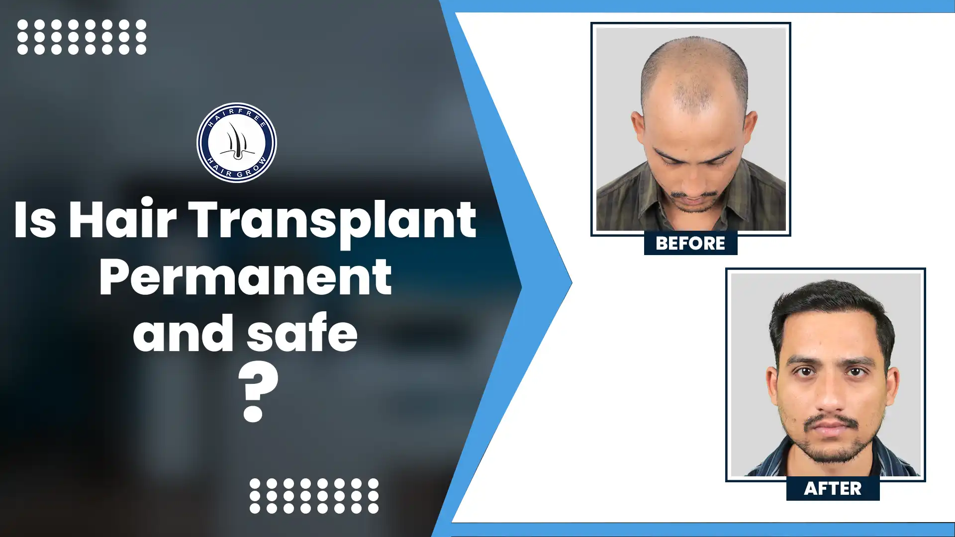 Before and after comparison showing results of hair transplant with text 'Is Hair Transplant Safe and Permanent?