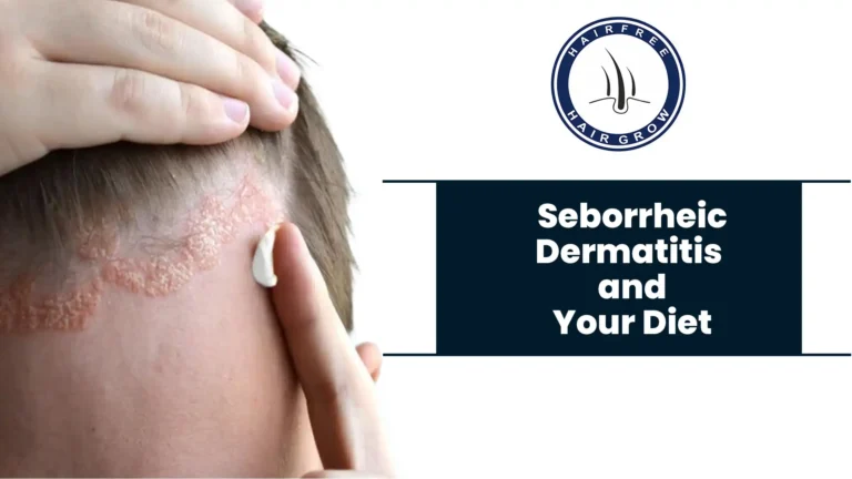 Seborrheic Dermatitis Diet: Applying cream to scalp with seborrheic dermatitis.