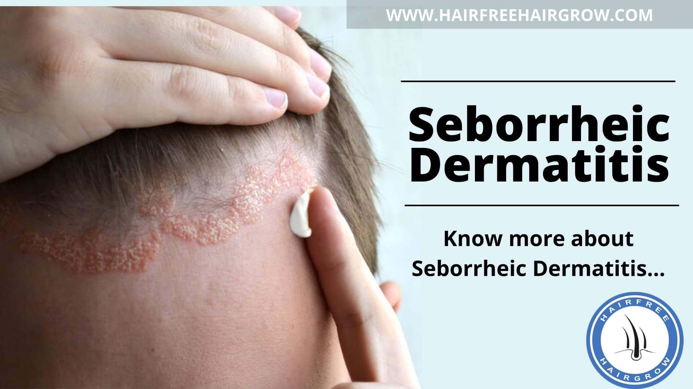a man applying cream on the infected area from the hair loss condition called seborrheic dermatitis