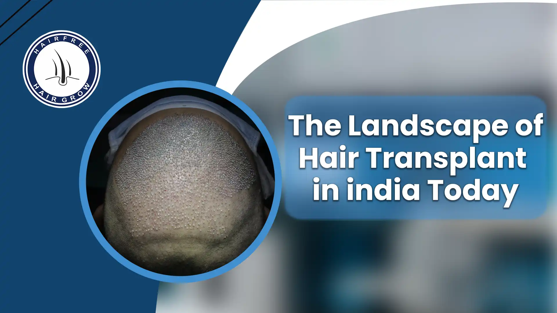 Expert Hair Transplant in India for effective and natural results