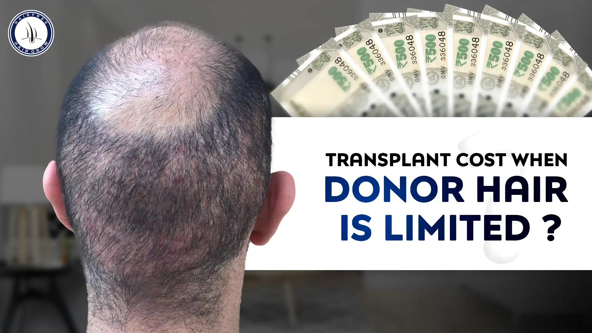 Donor area hair transplant procedure showcasing healthy hair extraction