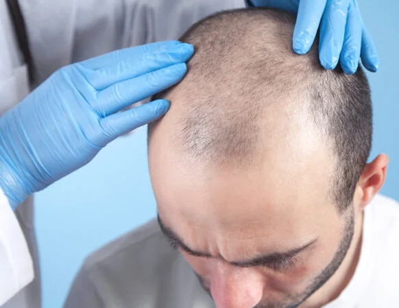 a doctor examining patient who has under gone Discover the revolutionary B-Fue , i fue technique for effective hair regrowth.