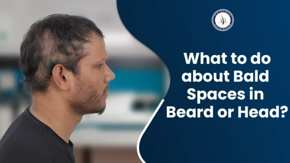 Bald spot in beard and head: A man with visible hair loss on his scalp and patchy beard, showing signs of alopecia