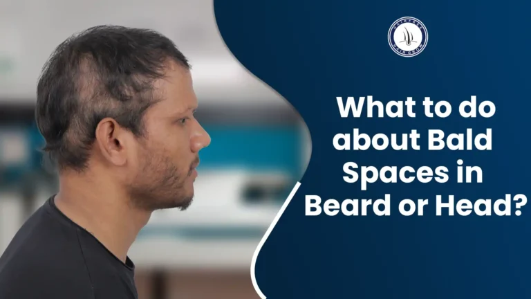 Bald spot in beard and head: A man with visible hair loss on his scalp and patchy beard, showing signs of alopecia