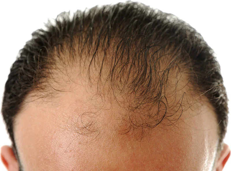 androgenetic alopecia example of hair loss
