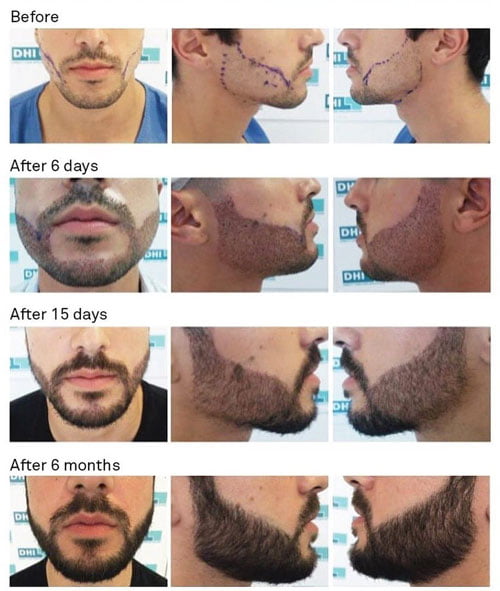 before and after results of beard male hair transplant treatment done