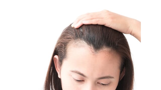 a woman showing hair loss at the side of scalp