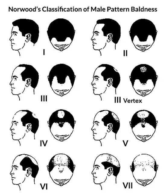 norwood's classification showing stages of male pattern hair loss