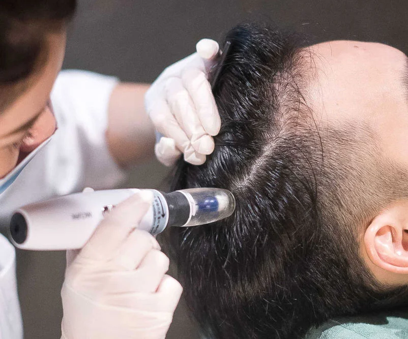 patient undergoing mesotherapy treatment for hair loss at hair restoration clinic