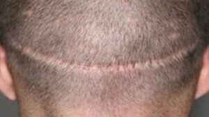 a back of head of a man showing strip harvesting of hair follicles