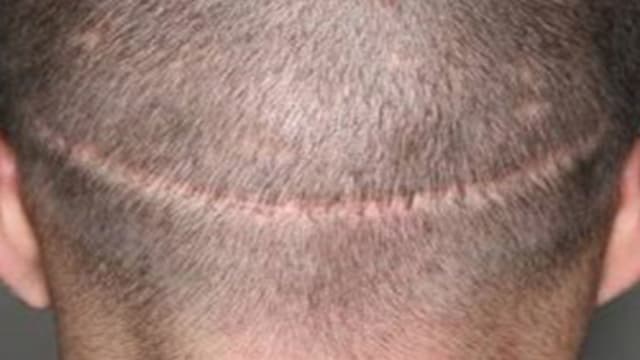 a back of head of a man showing strip harvesting of hair follicles