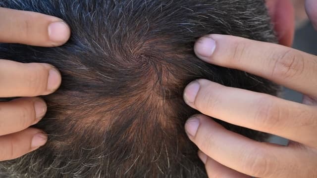 a bald crown area of a male patient at hairfree hairgrow clinic