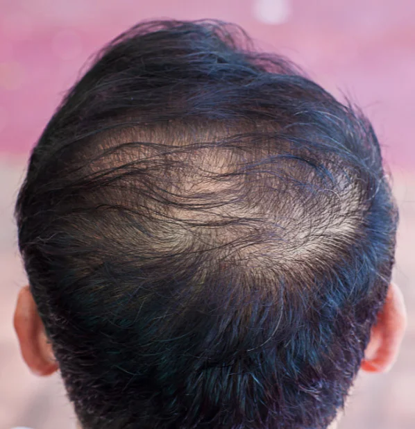 person suffering from Telogen effluvium hair loss showing his back side of head