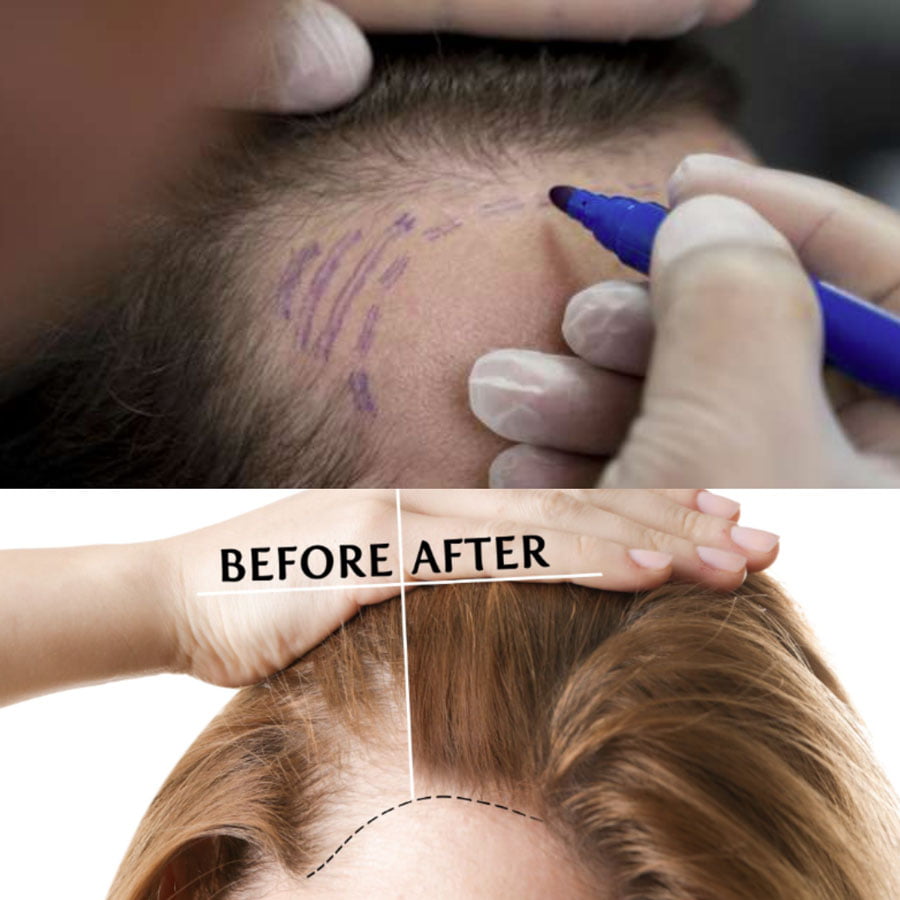 doctor marking head scalp for hairline reconstruction, also showing before and after results of hairline reconstruction treatment