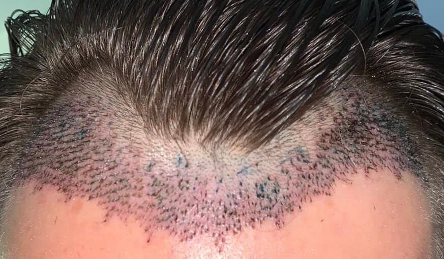 a male head with hair transplant procedure done on it for identifying worst hair transplant procedure