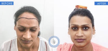 front view of before and after results of female hair loss treatment done at best hair transplant clinic in india hairfree and hairgrow clinic