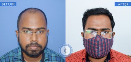 front view of before and after results of male hair transplant treatment done at best hair transplant clinic in india hairfree and hairgrow