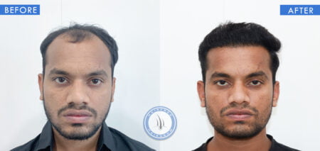 front view of before and after results of scarring cicatricial alopecia treatment done at best hair transplant clinic in india hairfreehairgrow