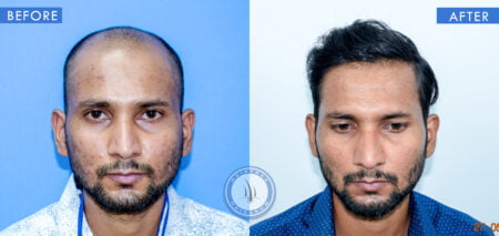 front view of before and after results of patchy hair loss treatment done at best hair transplant clinic in india hairfree and hairgrow clinic