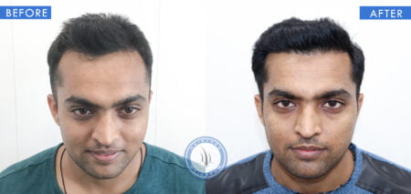 front view of before and after results of balding men treatment done at best hair transplant clinic in india hairfree and hairgrow clinic