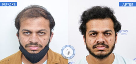 front view of before and after results of plasma hair treatment done at best hair transplant clinic in india hairfree and hairgrow clinic