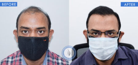 front view of before and after results of hair thinning treatment done at best hair transplant clinic in india hairfree and hairgrow clinic