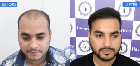 front view of before and after results of alopecia patches treatment done at best hair transplant clinic in india hairfree and hairgrow clinic
