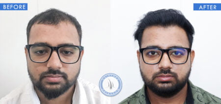 front view of before and after results of lllt therapy treatment done at best hair transplant clinic in india hairfree and hairgrow clinic