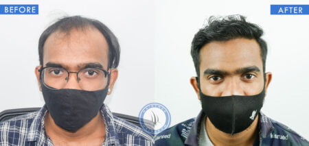 front view of before and after results of hair replacement treatment for men done at best hair transplant clinic in india hairfree hairgrow