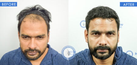 front view of before and after results of hair regrowth treatment done at best hair transplant clinic in india hairfree and hairgrow clinic