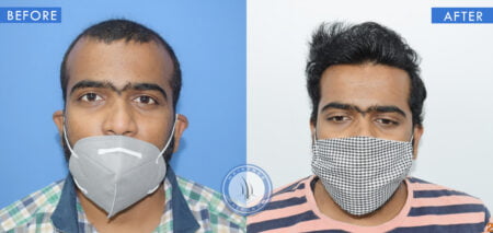 front view of before and after results of mesotherapy treatment done at best hair transplant clinic in india hairfree and hairgrow clinic