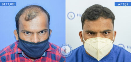 front view of before and after results of hair regrowth treatment done at best hair transplant clinic in india hairfree and hairgrow clinic