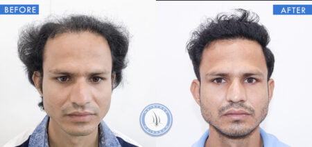 front view of before and after results of alopecia androgenetica treatment done at best hair transplant clinic in india hairfree hairgrow