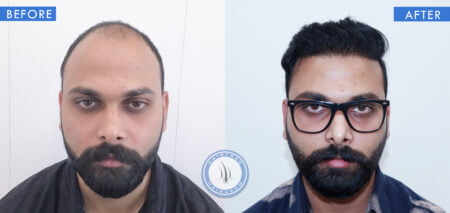 front view of before and after results of androgenetic alopecia treatment done at best hair transplant clinic in india hairfree and hairgrow