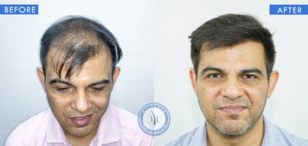 front view of before and after results of hair growth treatment done at best hair transplant clinic in india hairfree and hairgrow clinic