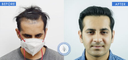front view of before and after results of hair follicle surgery treatment done at best hair transplant clinic in india hairfree and hairgrow clinic