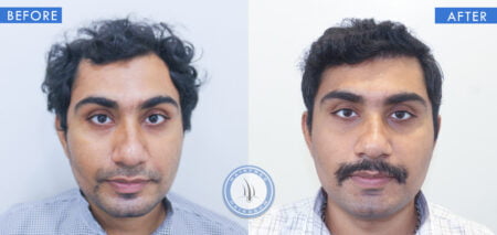 front view of before and after results of male baldness treatment done at best hair transplant clinic in india hairfree and hairgrow clinic