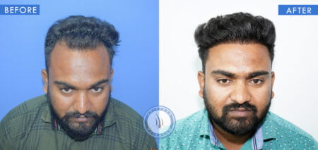 front view of before and after results of hair thinning treatment male done at best hair transplant clinic in india hairfree and hairgrow