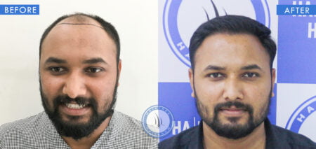 front view of before and after hair thinning at front male treatment done at best hair transplant clinic in india hairfree and hairgrow clinic