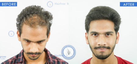 front view of before and after male pattern baldness cure treatment done at best hair transplant clinic in india hairfree and hairgrow clinic